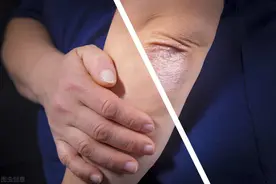 炎炎夏日也要穿长裤长袖，银屑病怎么治？外用药速达皮损让美展现图片