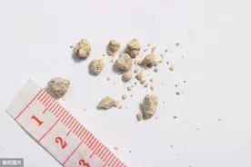 肾结石术后为啥留个“小尾巴”图片
