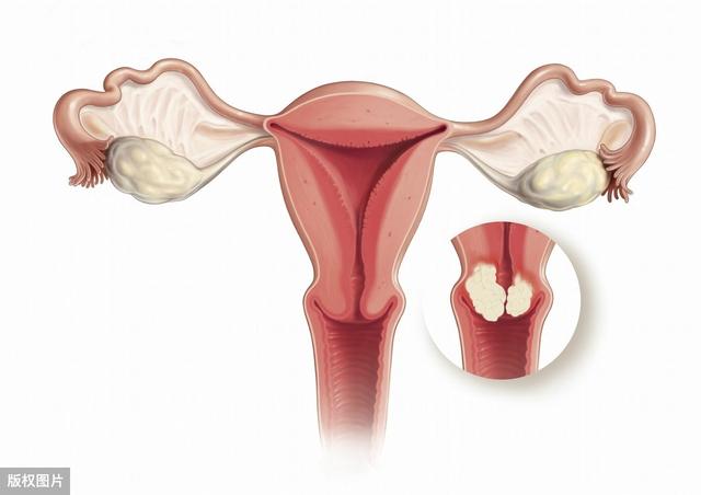 外阴鳞状上皮过度角化不全