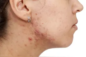 中医治痤有妙招——8种常见痤疮外治法，值得收藏图片