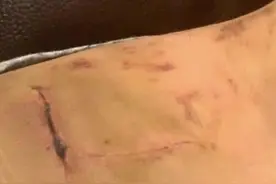 大嫂徐冬冬晒脂肪瘤术后照，伤口狰狞疤痕明显！哭诉工作太心酸图片