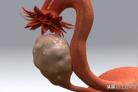 一次切除25个子宫肌瘤，一月后又长15个，原因是不正确的饮食方式图片
