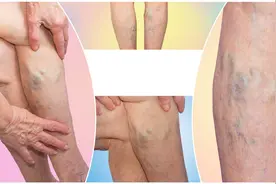 什么是下肢静脉曲张？腿部肿胀“青筋凸起”要重视，7措施早预防图片