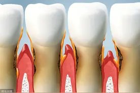 出现牙龈萎缩怎么办？它能自己长回去吗？看看牙科医生怎么说图片