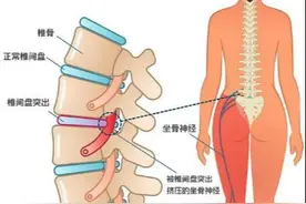 名医专访 | 上海长征医院史国栋：腰椎间盘突出是怎么引起的？图片