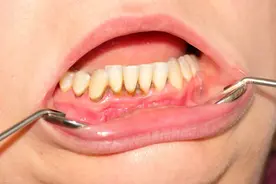 牙齿健康要走出哪些治疗误区图片