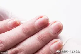 来自老中医的提醒，掰手指“咔嚓作响”是好是坏？图片