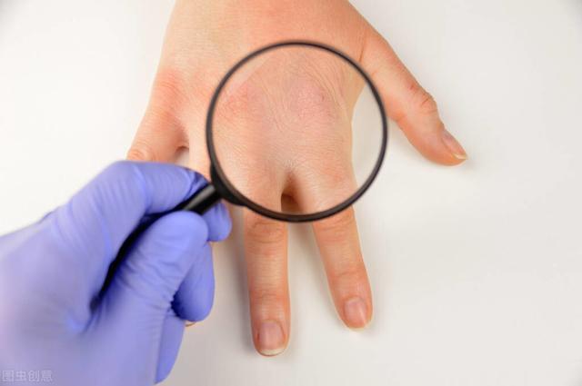 鱼鳞病得病几率