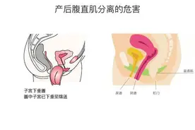 产后盆底肌松弛的训练图片