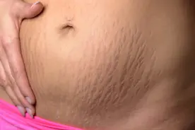 长妊娠纹怎么办？妊娠纹该怎么消除呢？医生告诉你如何正确消除图片