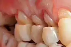 “最近吃饭遇到甜酸冷热牙齿疼痛难受”！这是是什么原因图片