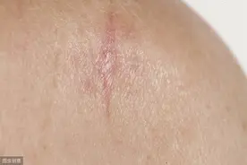 这5种皮肤异常不是单纯的皮肤病,警惕是皮肤癌图片