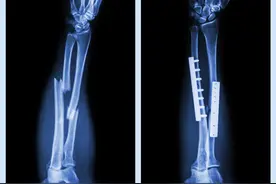 打到身体里的钢板要取吗？取出后要注意什么？图片