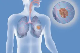 肺癌可以完全治愈吗？医生告诉你1个治疗的好方法，早知早预防图片