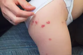 丘疹性荨麻疹：身上长了一粒一粒的小疙瘩，伴有剧烈的瘙痒图片