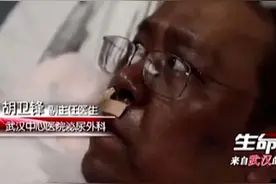 武汉医生保命成功，全身变黑，是ECMO副作用？专家不再回避图片