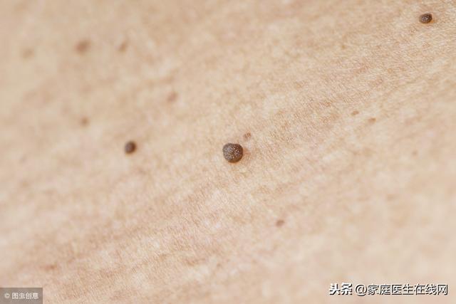 长了扁平疣怎么办?试试3个方法,"消灭"这些小疙瘩