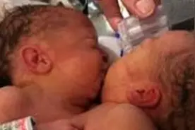 美国女子怀孕5个月查出胎儿是连体双胞胎，俩孩子出生时紧紧拥抱图片