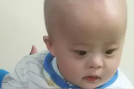 记录唐氏儿合并婴儿痉挛症儿子这两年的求医历程图片