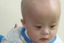 记录唐氏儿合并婴儿痉挛症儿子这两年的求医历程图片