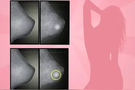 乳腺癌也要拍片检查吗图片