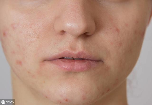 痤疮按照严重程度分4级,不同症状用药建议,收藏