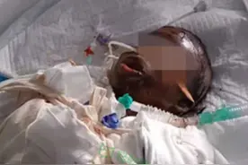 14岁女孩模仿短视频被重度烧伤，家人：孩子吃完饭就看手机图片