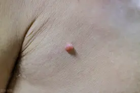 颈部长小肉球，抠掉会怎么样，如何处理，医生给你说明白了图片