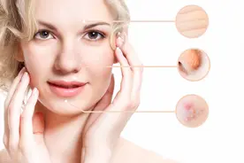 下巴长痘的原因，为什么下巴总是长痘？图片