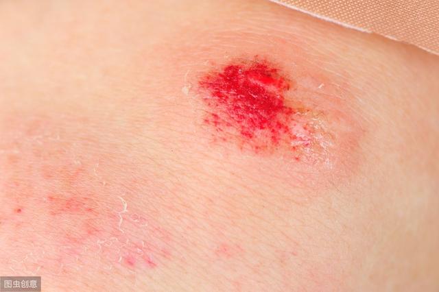 化疗期间能不能用身体乳