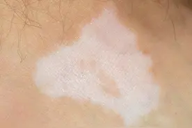 白癜风患者除了维生素C之外，这一种物质也是需要注意的图片