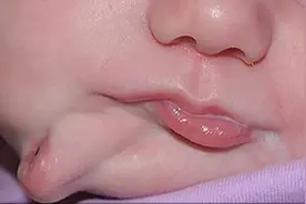 美国女婴长了两张嘴，第二张嘴中有完整的牙齿舌头，还分泌唾液图片