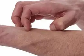 5个灭湿疹的小方，和反反复复的湿疹说再见图片