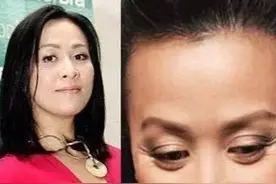 注射除皱的危害是什么？注射除皱的方法有哪些？图片