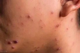 得了性病不要怕，除了HIV我们都有办法图片