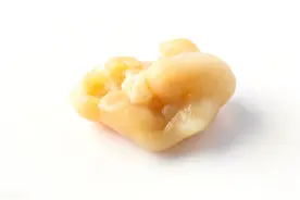小伙嘴里咳出石头，医生表示，自查一下，你可能也有图片