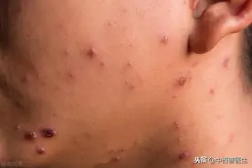 梅毒患者在日常生活中能进行传播吗？图片