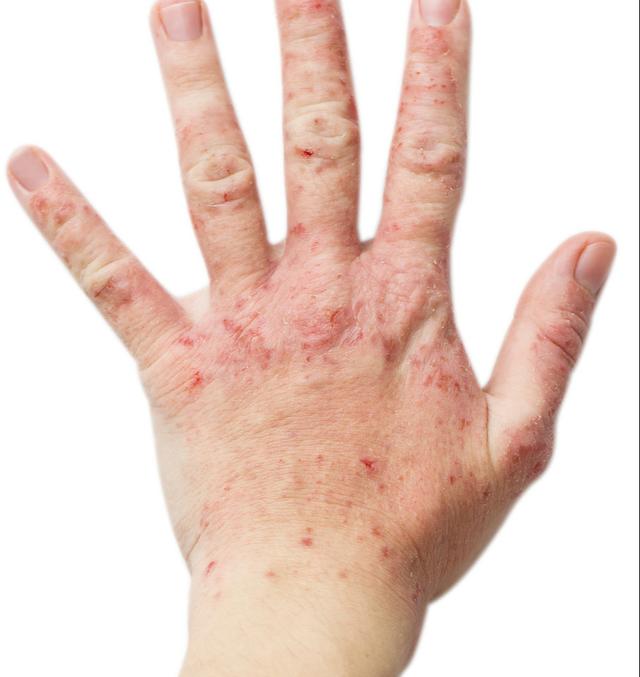 皮肤用药:曲安奈德益康唑,跟他克莫司软膏有什么区别?