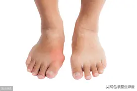 尿酸高到多少必须吃药？得分3种情况对待，第一种不吃药也能行图片