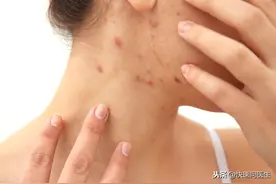 惹上皮炎，瘙痒难耐？别慌，做到这五点，轻松搞定皮肤烦恼图片