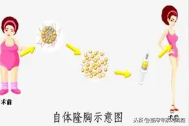 假体隆胸后感觉太假，取出以后可不可以做自体脂肪隆胸？图片