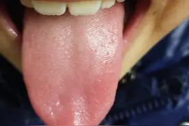 看舌头知体质对症吃中药防病毒图片