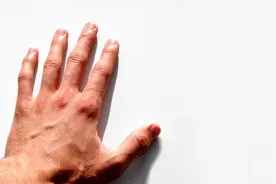 手脚青筋特别明显，是不是血管堵了？医生：这种情况要格外注意图片