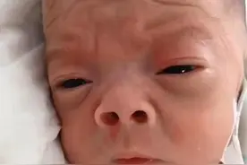 “怪异宝宝”照片走红，面似外星人让宝妈崩溃，90天后完美逆袭图片