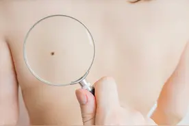 大师说：这颗痣霉运的症状，一定要去？医生告诉你图片