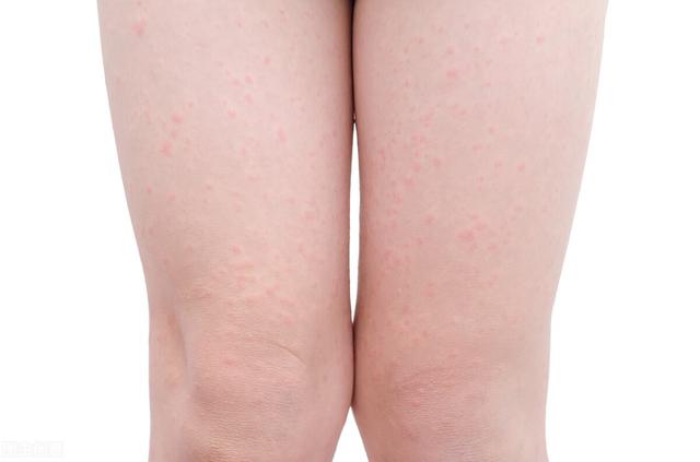 皮肤出现泛红鸡皮肤颗粒状