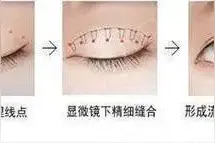 埋线、三点式、全切双眼皮有什么区别？图片