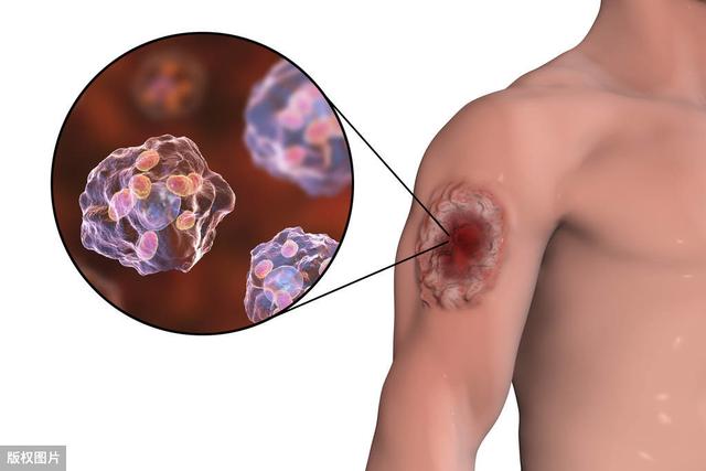 外阴鳞状上皮过度角化不全