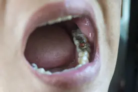 当孩子出现这20种牙颌畸形问题，为了他们好，12岁前就要解决图片