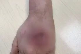 警惕！女子洗鱼被刺后未在意，手背长出大窟窿差点截肢图片